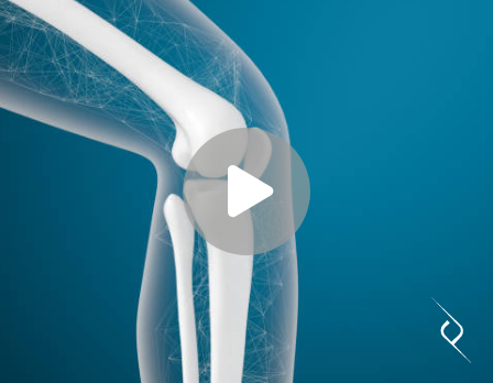 Artroplastia total do joelho
